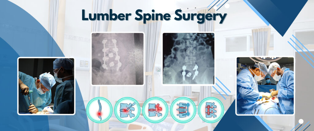 Lumber Spine Surgery in surat