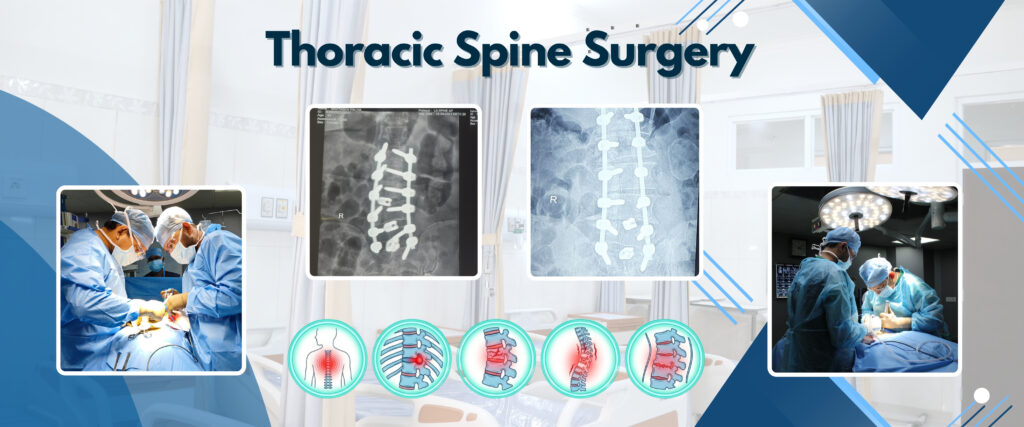 Advanced Thoracic Spine Surgery in Surat